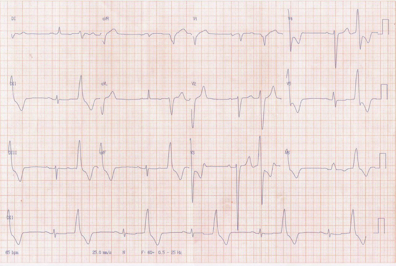 Paciente masculino de 74 años portador de miocardiopatía chagásica que se halla en clase funcional III y tiene elevado riesgo de MS