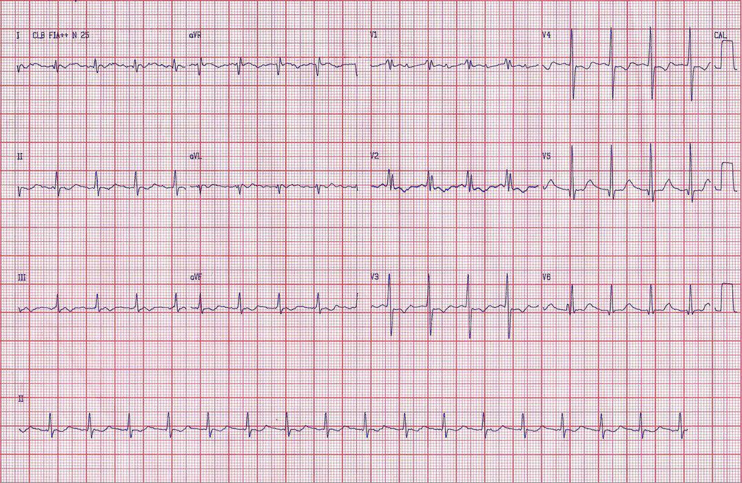 Paciente cursando postoperatorio de reemplazo valvular mitral que presenta taquicardia auricular 2:1