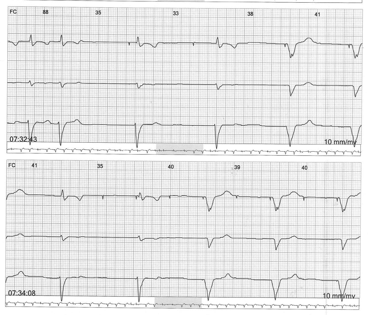 Hombre de 63 años, HTA y DBT que cursa cuadro de insuficiencia renal aguda con hiperkalemia a quién se implanta MP transitorio por bradiarritmia, con captura intermitente