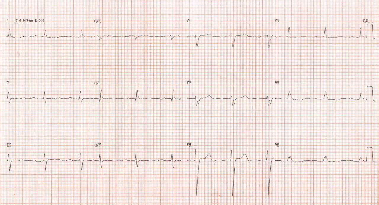 Paciente en el que se implanta CDI y que a posteriori presenta disnea súbita por la ocurrencia de un meumotórax