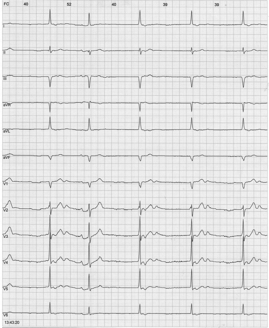 Mujer de 95 años con mareos y fatiga que presenta disfunción del nódulo sinusal atribuible a efecto de quetiapina con la que era tratada