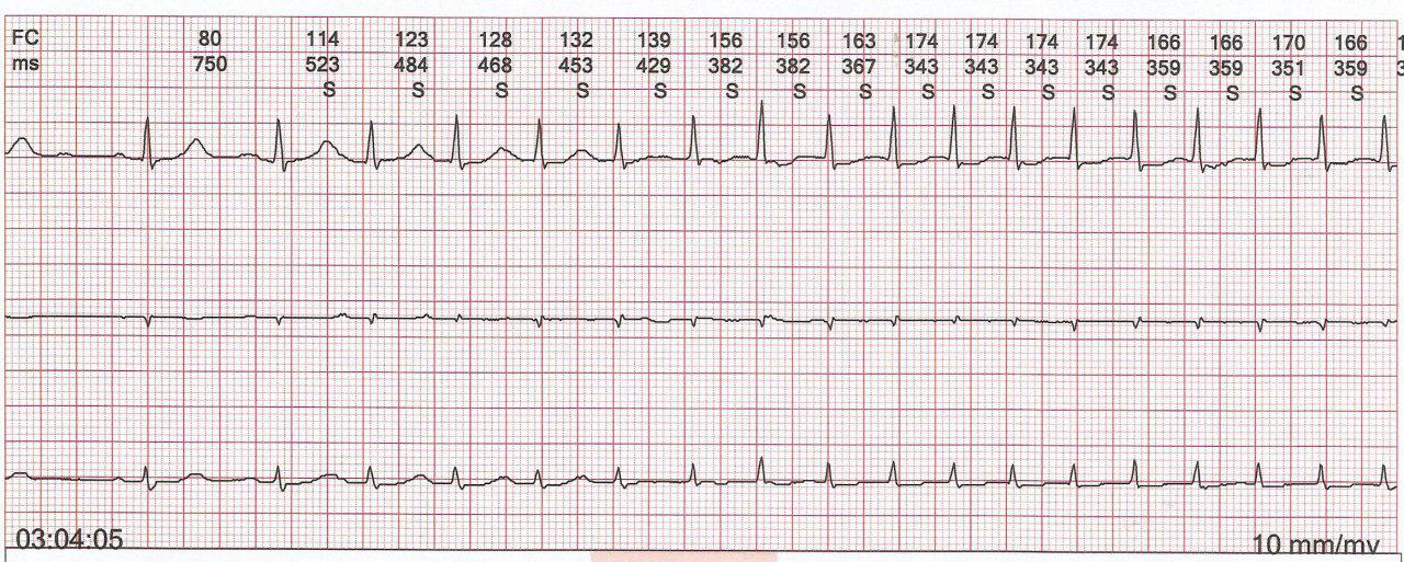 Hombre de 82 años con palpitaciones por taquicardia auricular por reentrada que termina con una P retroconducida con RP´corto de 80ms