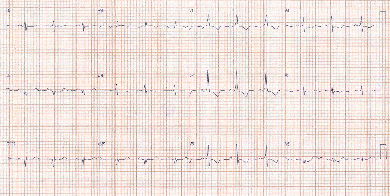 Mujer de 66 años con disnea de esfuerzo y dolor en HD cuya Rx presenta prominencia de orejuela de AI, elevación del bronquio principal izquierdo y crecimiento de AI por estenosis mitral con HTP