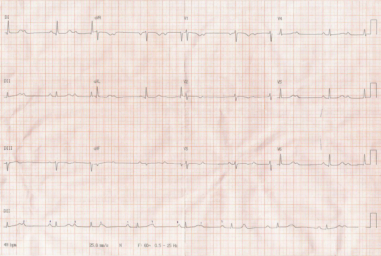 Paciente femenina de 47 años con mareos y fatiga por presentar BAV 2:1 y de más alto grado que requiere MP