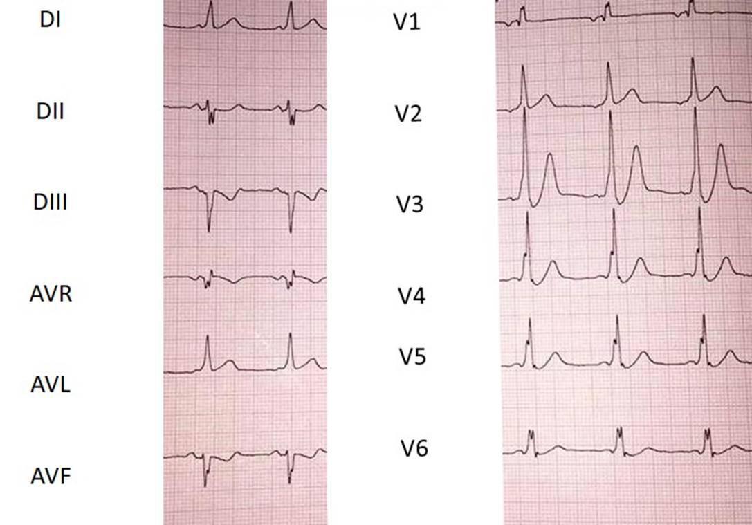 Hombre de 64 años portador de WPW que cursa con SCA por compromiso de 1º diagonal observándose cambio de polaridad de onda T en V2 luego de la angioplastia