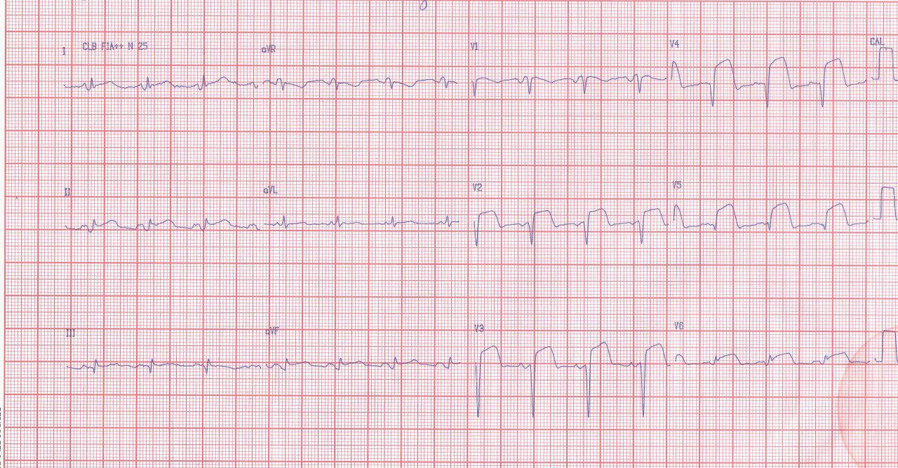 Mujer de 64 años con factores de riesgo que presenta angor prolongado por infarto agudo de cara anterior e infarto de aurícula por compromiso de DA proximal