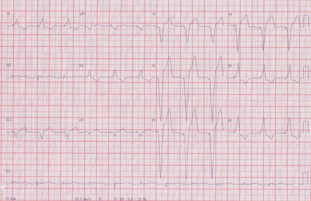Paciente portador de MP que presenta episodio de angor, troponina normal y cuya CCG muestra arterias coronarias normales, siendo el dolor atribuible a disicronía ventricular