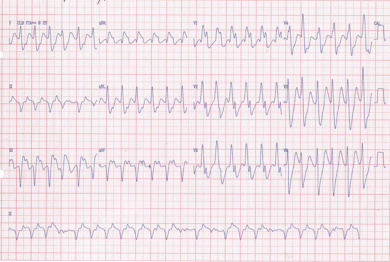 Paciente que presenta episodio de TV en el contexto de infarto antiguo de cara inferior