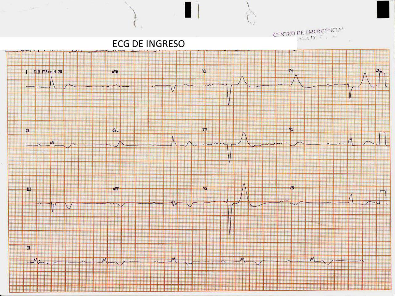 Mujer de 63 años, hipertensa y diabética con insuficiencia renal crónica e hiper K que presenta episodios sincopales por BAVC