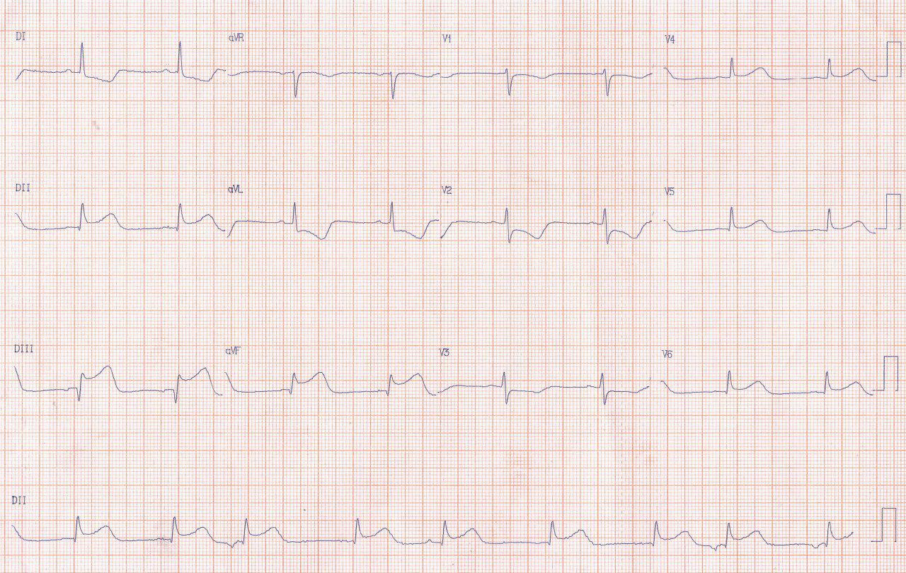 Ritmo auricular ectópico en el contexto de SCA con compromiso de la arteria del nódulo sinusal
