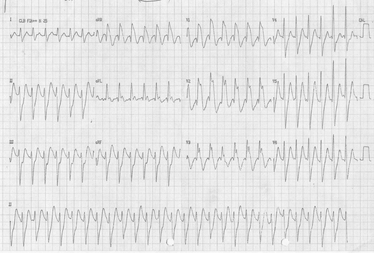 Varón de 25 años con historia de palpitaciones y antecedente de padre fallecido súbitamente a los 55 años, en quién se constata TV fascicular y síndrome de Brugada