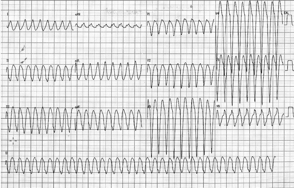 Hombre de 63 años portador de miocardiopatía dilatada, en insuficiencia cardíaca con arterias coronarias normales, que presenta episodio sincopal debido a TV
