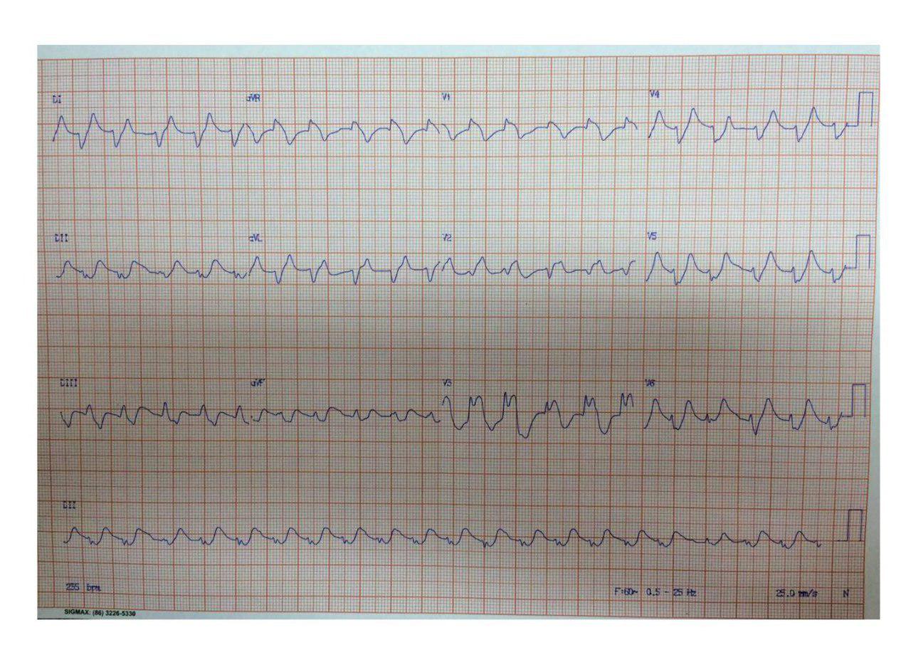 Paciente masculino de 81 años con severa hiperK de 9,6mEq/ml que presenta TV y recibe CVE
