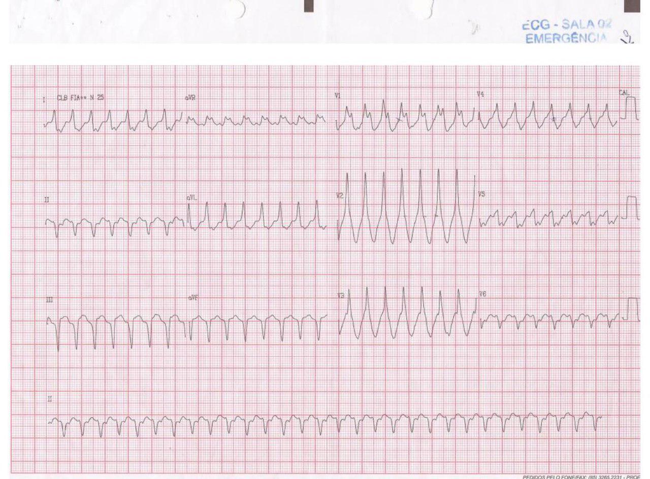 Hombre de 62 años que presenta episodio súbito de disnea e inestabilidad hemodinámica por presentar TV en contexto de sarcoidosis pulmonar y sarcoidosis cardíaca constatada por biopsia endomiocárdica