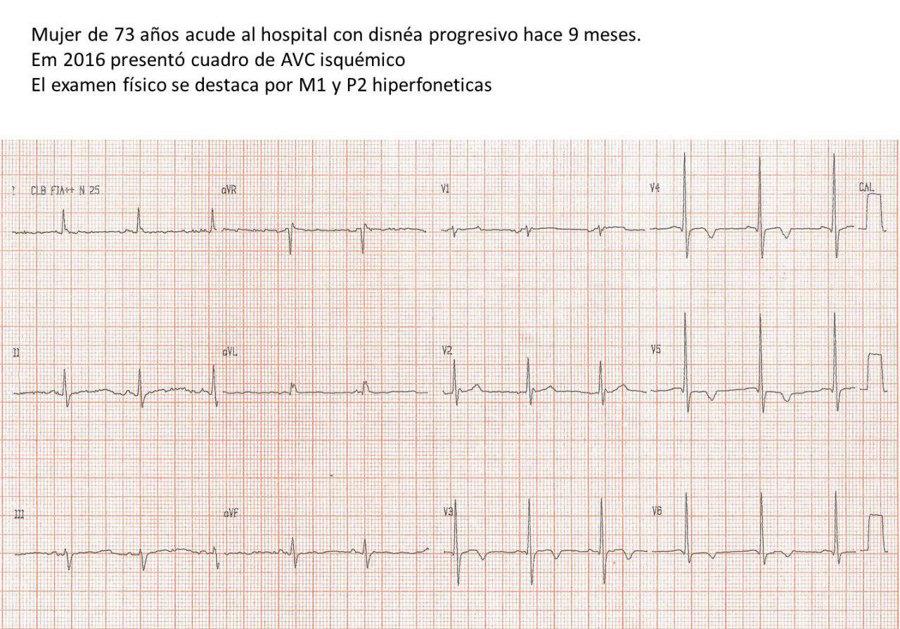 Mujer de 73 años con antecedente de ACV isquémico que presenta disnea progresiva atribuible a un mixoma de aurícula izquierda