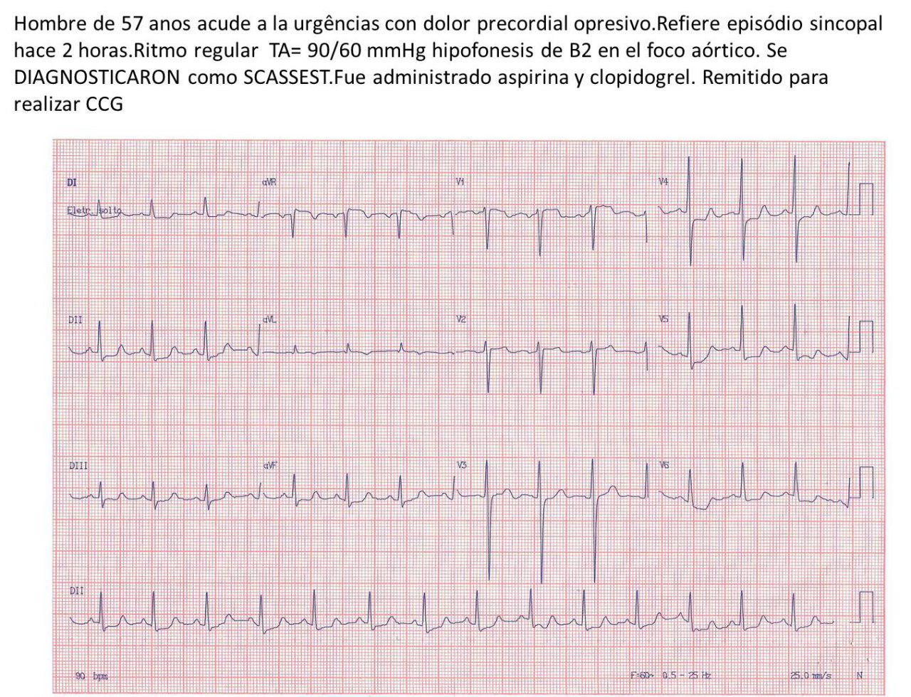 Hombre de 57 años que presenta angor y episodio sincopal atribuibles a estenosis aórtica severa calcificada
