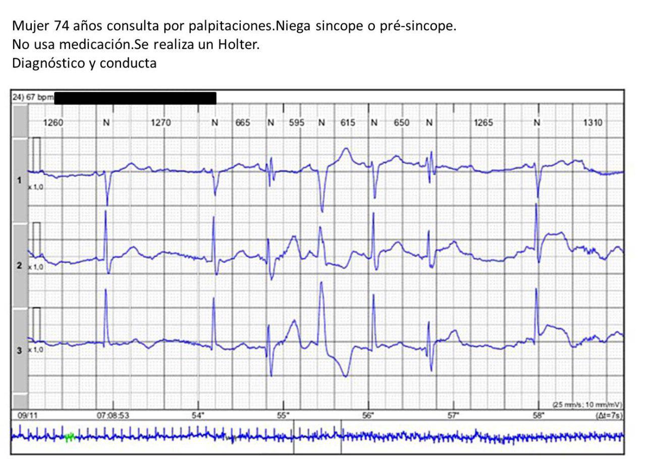 Mujer de 74 años que refiere palpitaciones y que presenta bloqueo de rama bilateral alternante