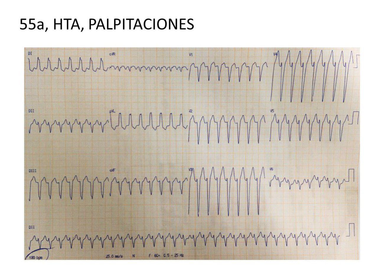 Paciente de 55 años con palpitaciones por presencia de TPSV con complejos aberrantes, que revierte con adenosina