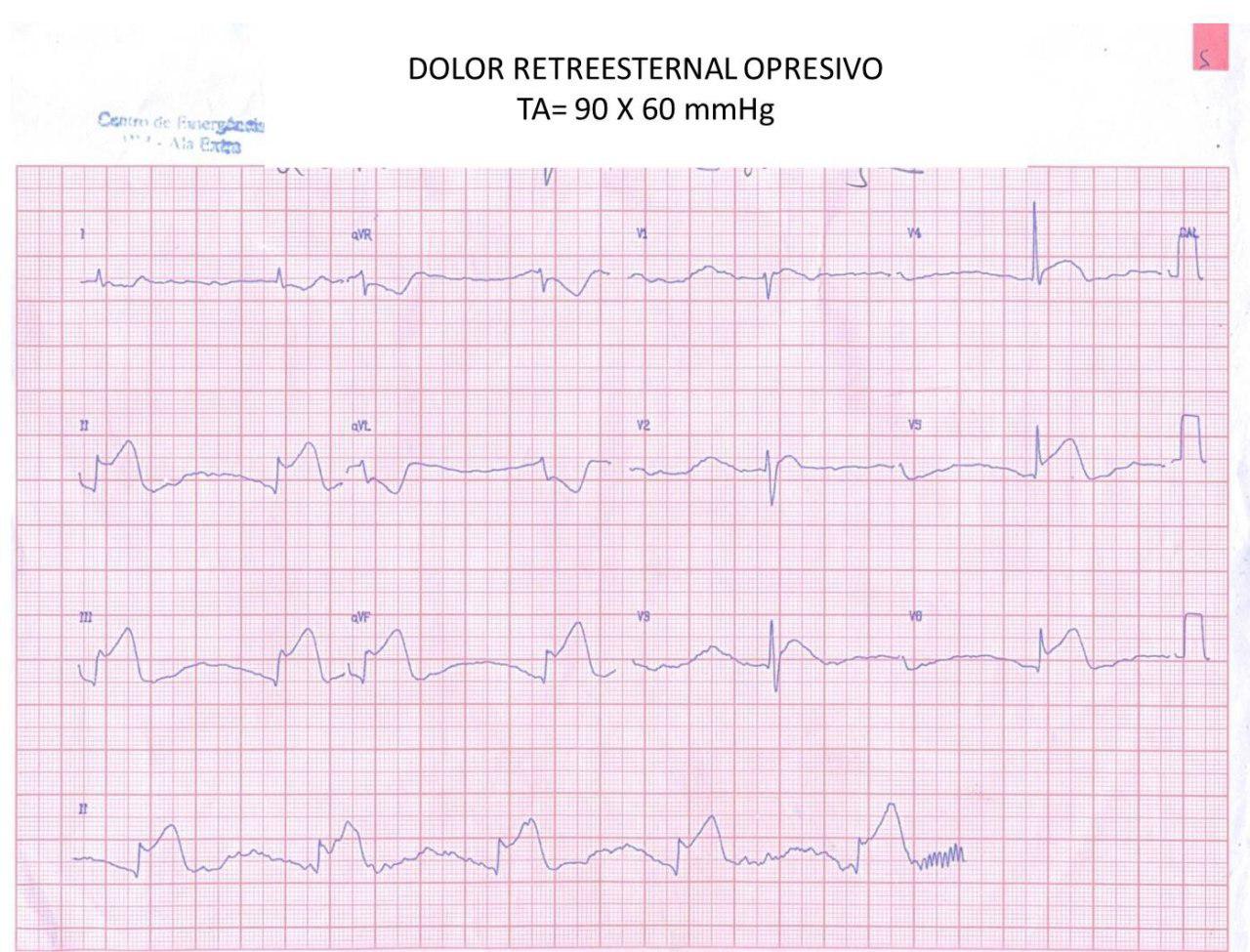 Paciente que presenta SCA que afecta VD por compromiso de Cx con implante de stent, trombosis intrastent e implante de uno nuevo