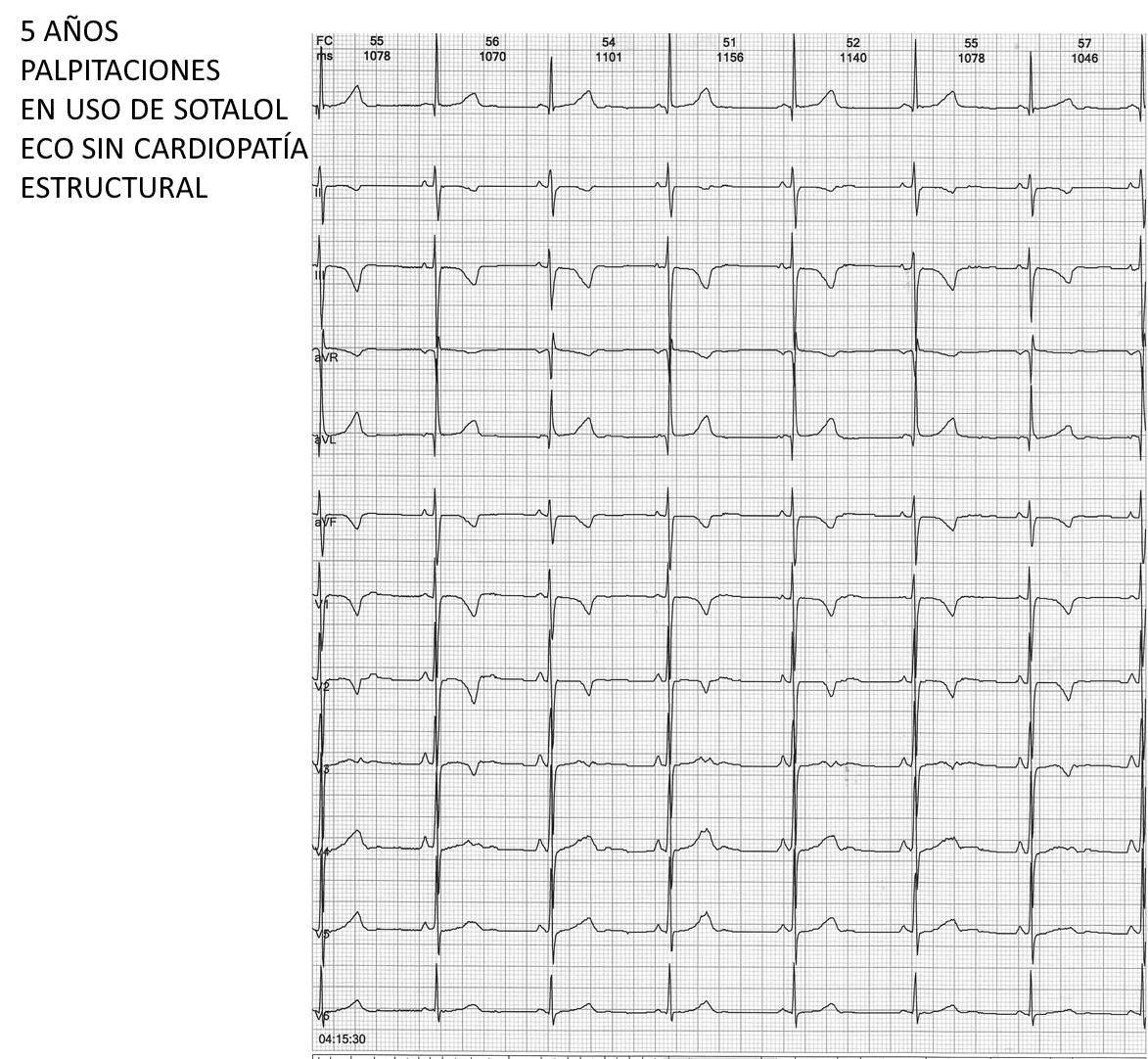 Niño de 5 años con EVs muy frecuentes en contexto de corazón estructuralmente normal a quién se indicó sotalol