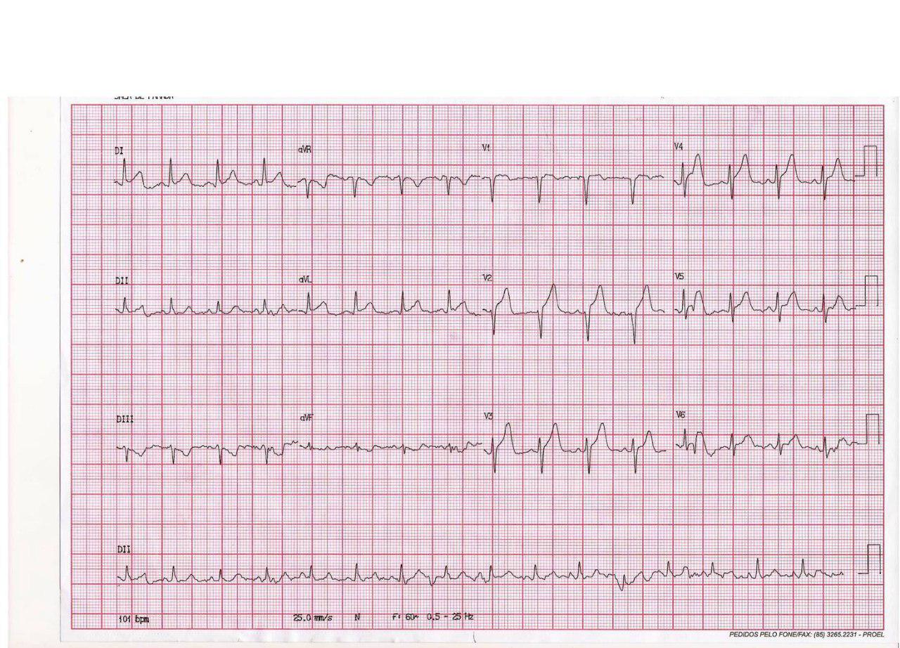 Paciente de 67 años con SCA por compromiso de la DA proximal y posterior migración de trombo a 1º septal