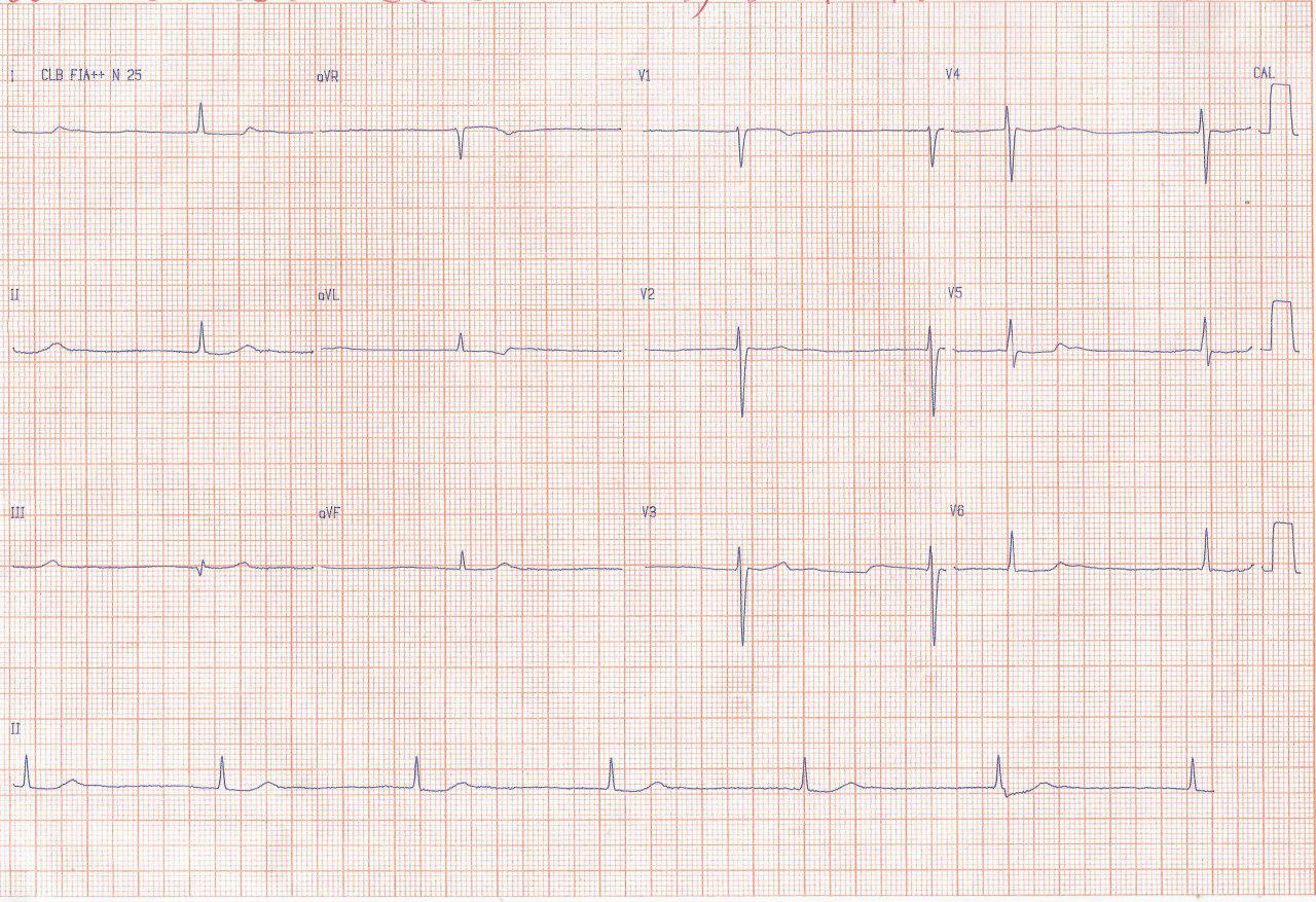 Mujer de 59 años con disnea y mareos atribuibles a presentar ritmo de la unión AV por intoxicación digitálica y efecto B bloqueante con mejoría al suspender las drogas