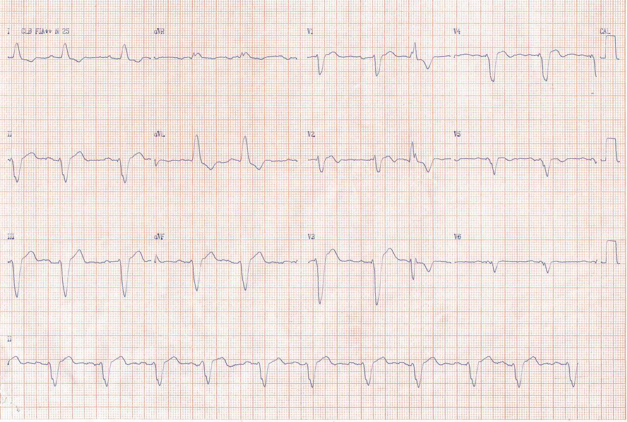 Paciente masculino portador de MP que presenta angor y disnea por SCA por compromiso de la arteria 2º diagonal