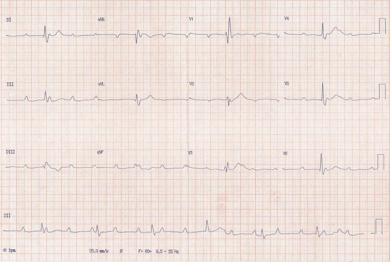 Hombre de 66 años, HTA y DBT en tratamiento antipsicótico y portador de enfermedad de Lev, que presenta episodios sincopales a quién se implanta MP transitorio que se desplaza y requiere recolocación