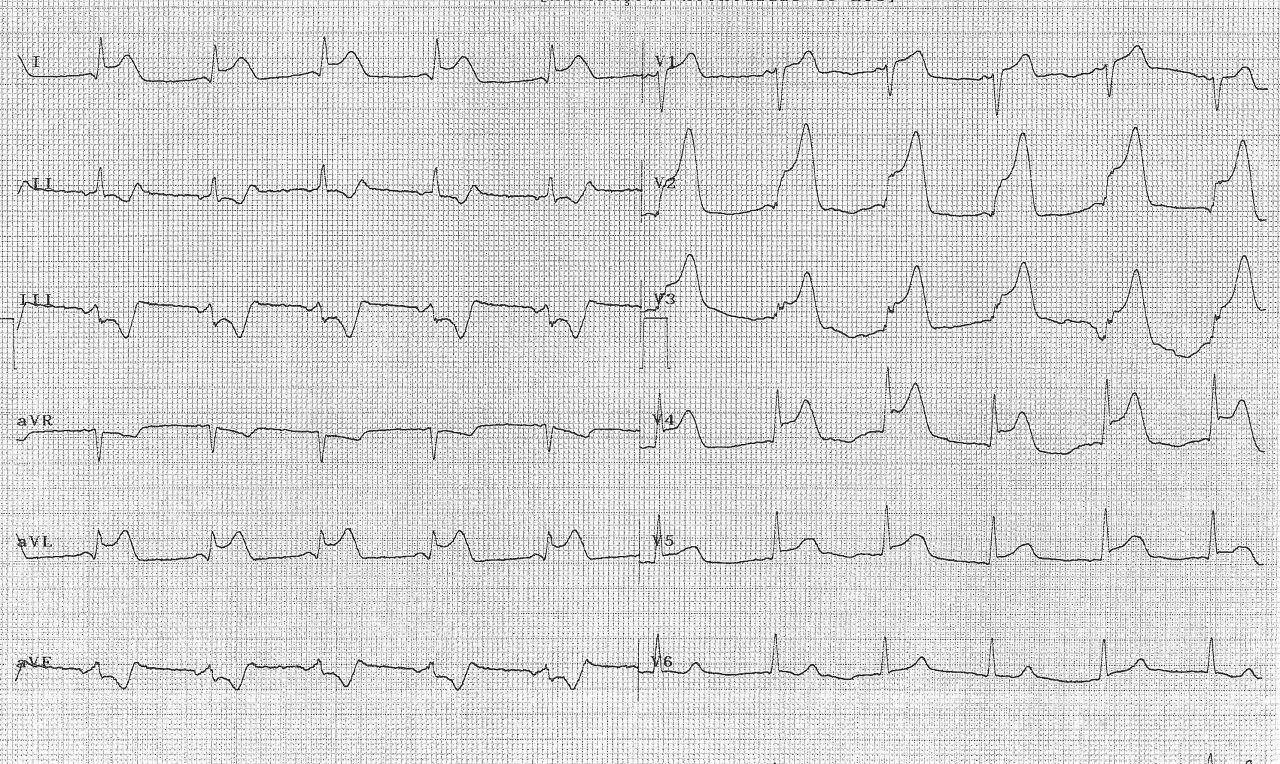 Hombre de 45 años con SCA que desarrolla FV  y shock cardiogénico con ruptura de pared y evolución al óbito