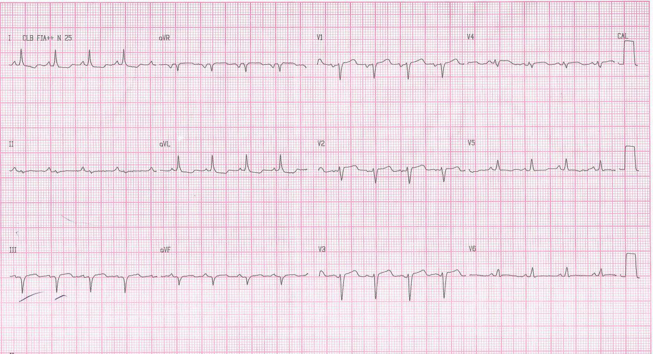 Mujer de 59 años fumadora de larga data e infarto inferior previo que cursa con angor y disnea por enfermedad multivasos