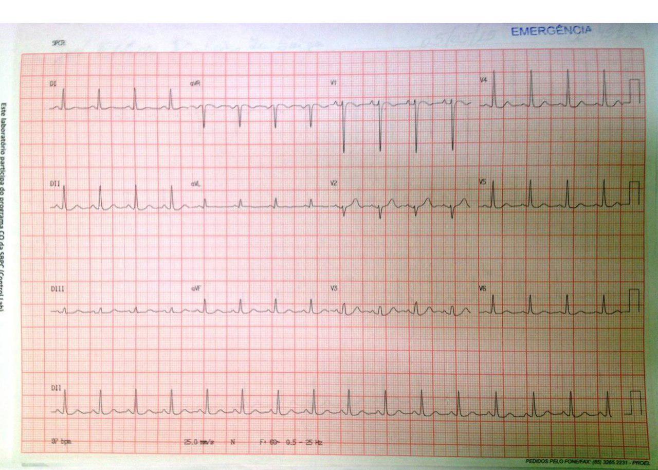 Hombre de 44 años recuperado de FV por presentar EVs con acoplamiento corto