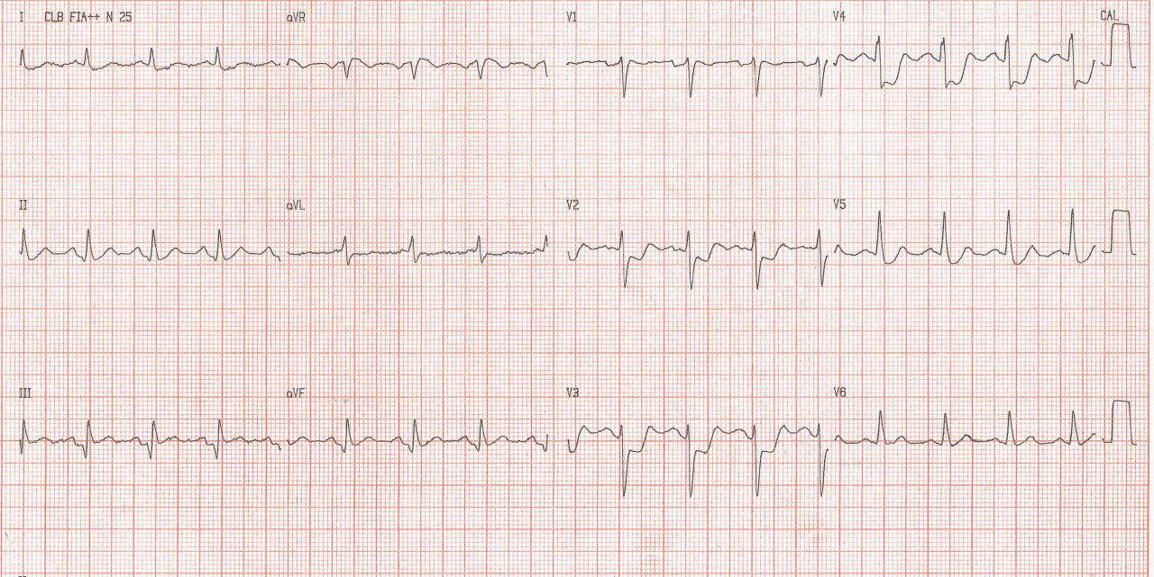 Hombre de 61 años con antecedente de infarto inferior previo que presenta angor prolongado por oclusión total de DA y Cx