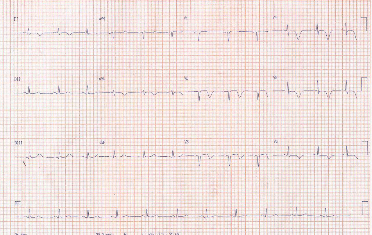 Paciente hipertenso y diabético que durante episodio de angor prolongado por compromiso de la DA proximal, presenta pseudonormalización de la onda T