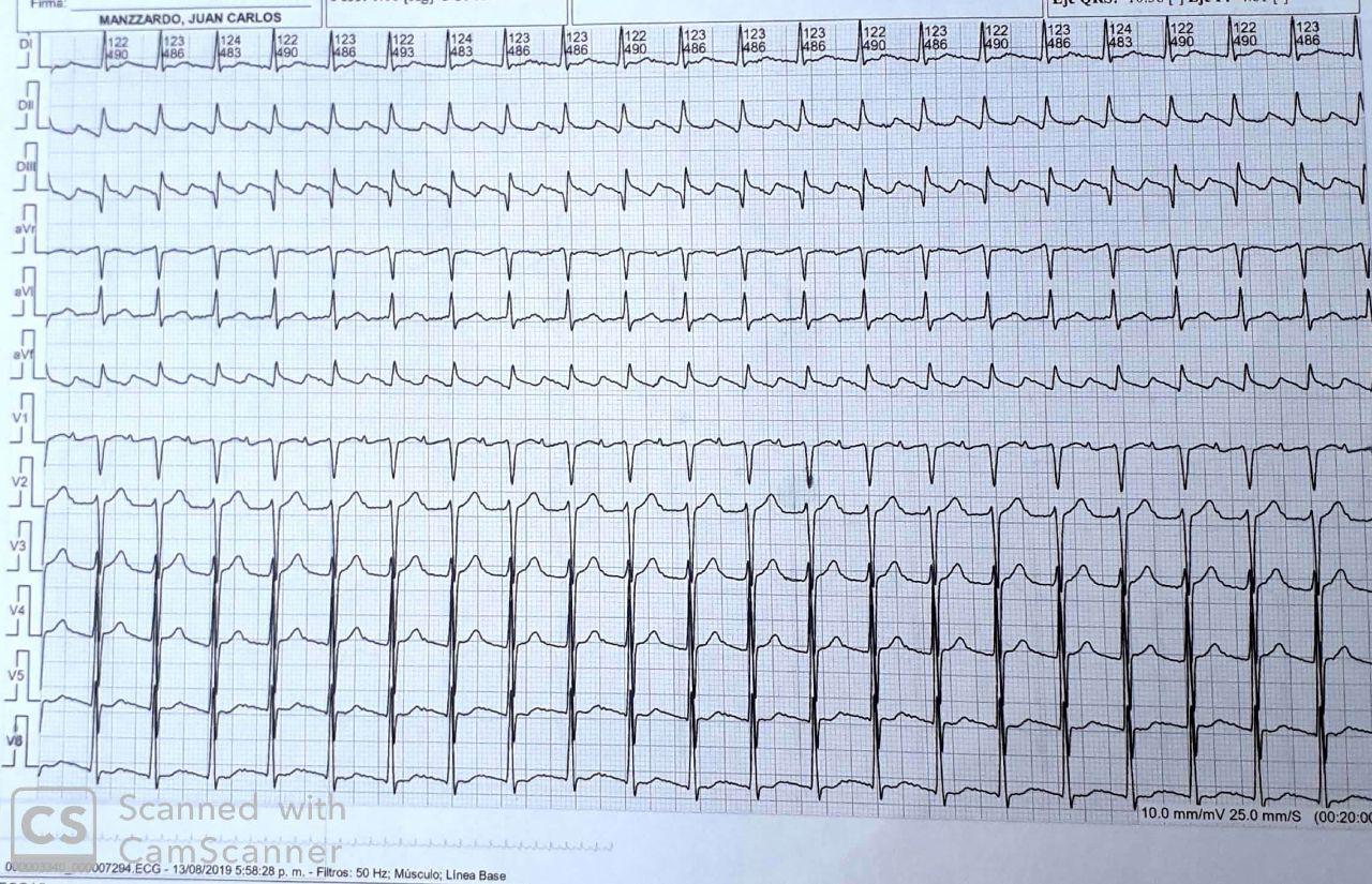 Paciente masculino de 70 años con factores de riesgo que presenta AA antihorario en contexto de BIA atípico avanzado de 1ª al que se efectúa ARF del itsmo CT exitosa