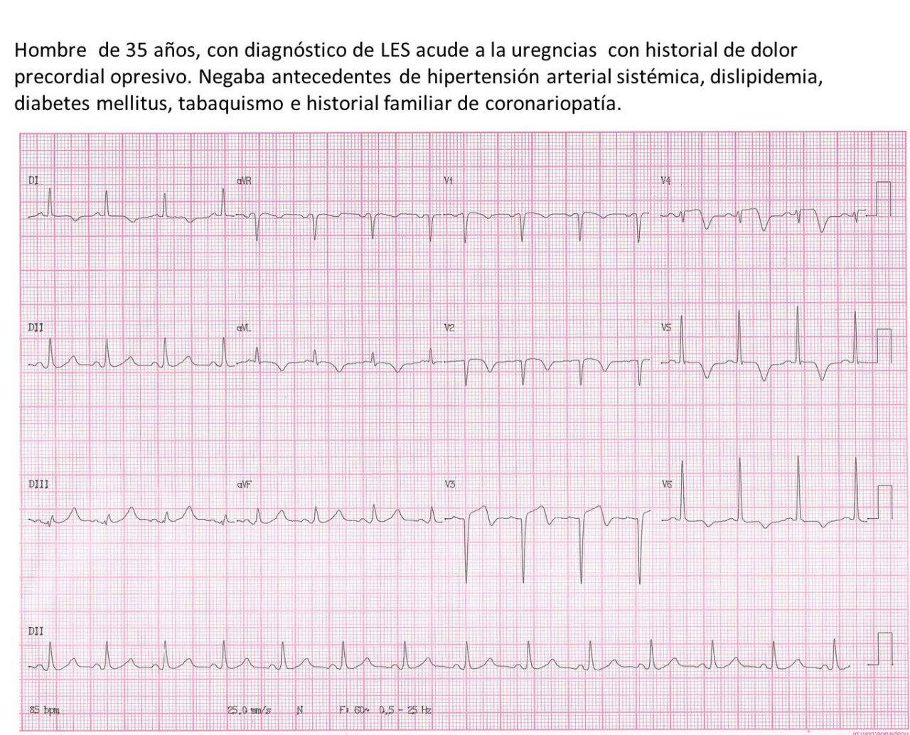 Paciente masculino de 35 años portador de lupus eritematoso sistémico que cursa con SCA por suboclusión y trombo en arteria DA