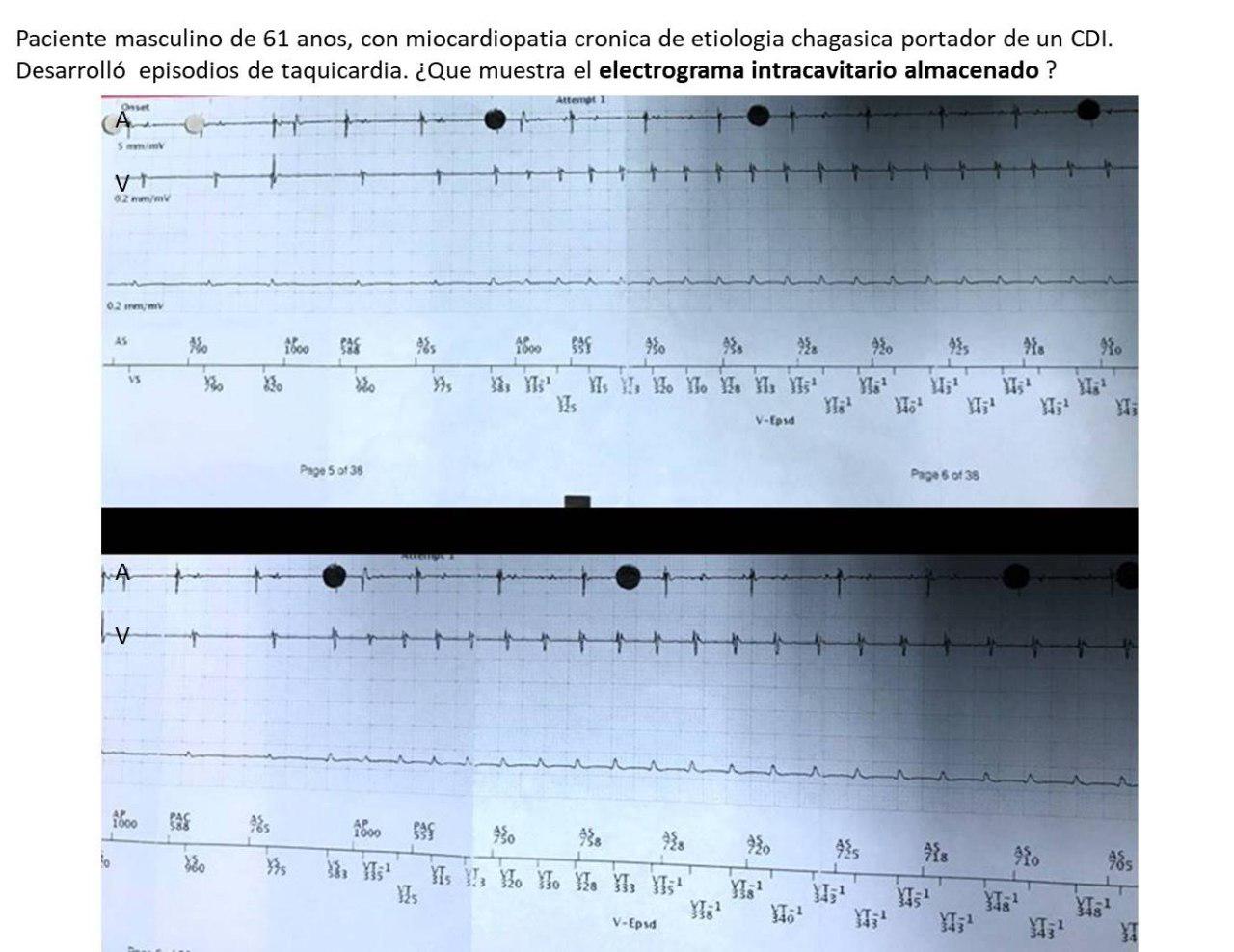 Paciente masculino de 61 años con miocardiopatía crónica chagásica portador de CDI que presenta episodio de taquicardia ventricular