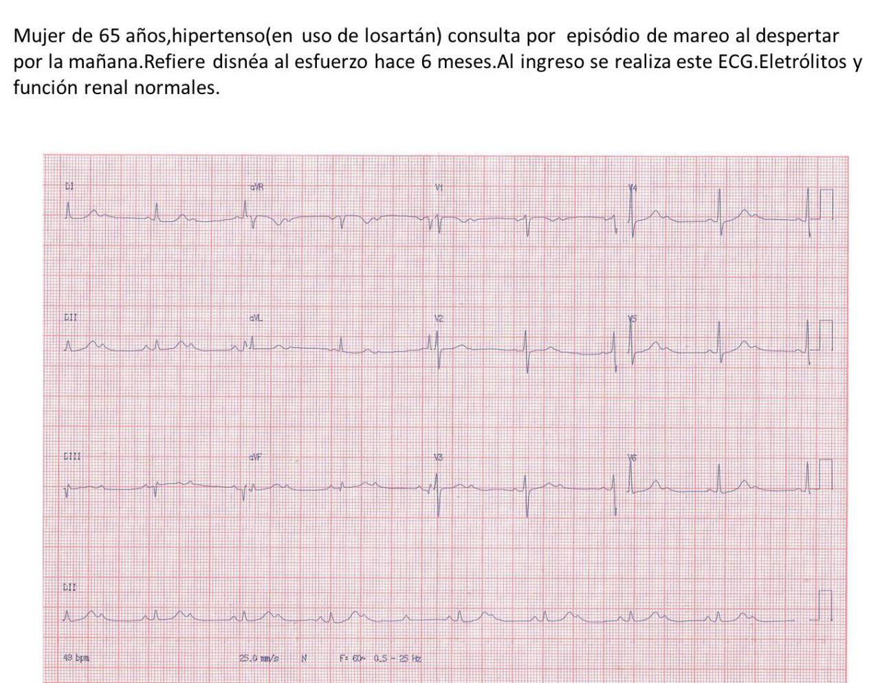 Mujer de 65 años hipertensa con mareos por presentar BAV de alto grado atribuible a hipotiroidismo