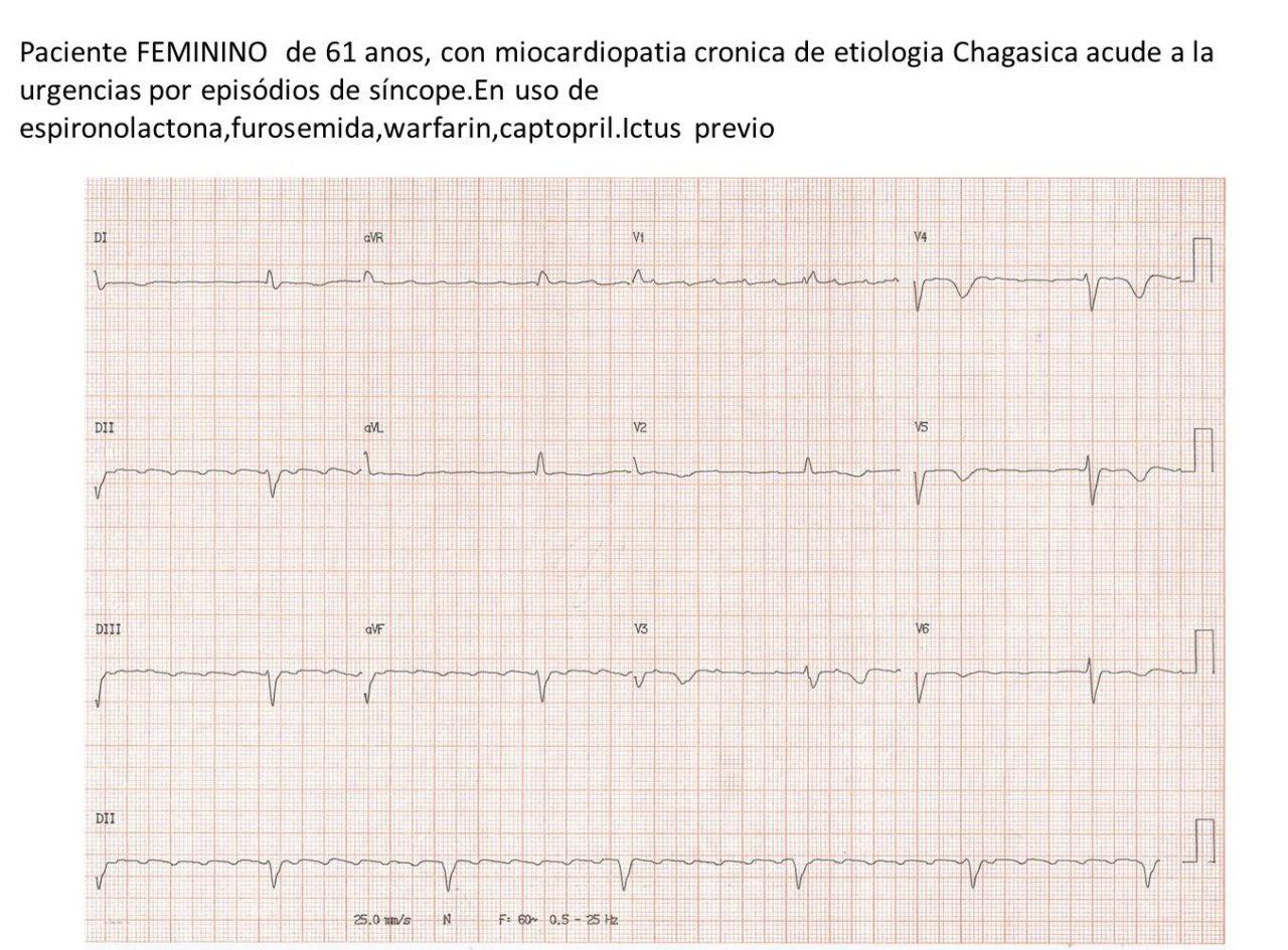 Mujer de 61 años con antecedentes de ictus previo, portadora de miocardiopatía chagásica crónica que presenta episodios sincopales