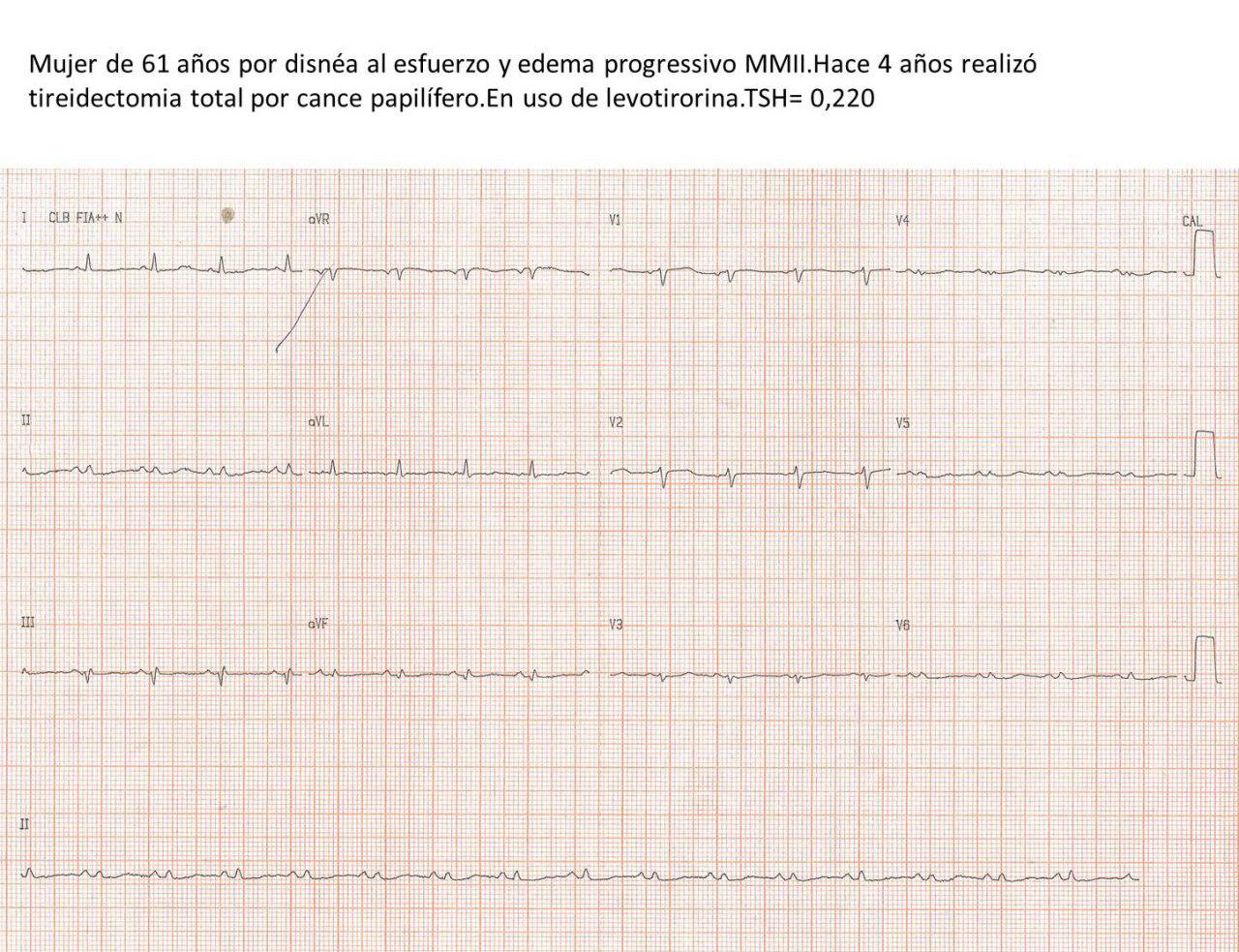 Mujer de 61 años con antecedente inmediato de tiroidectomía por CA papilífero que presenta derrame pericárdico severo por probables metástasis
