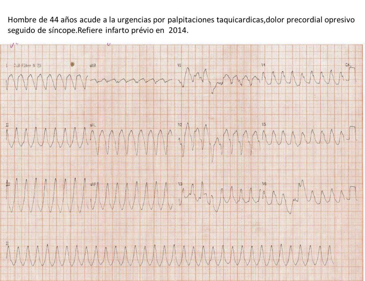 Paciente masculino de 44 años con historia de infarto previo que presenta palpitaciones, disnea y síncope por presencia de TV originada en aneurisma apical