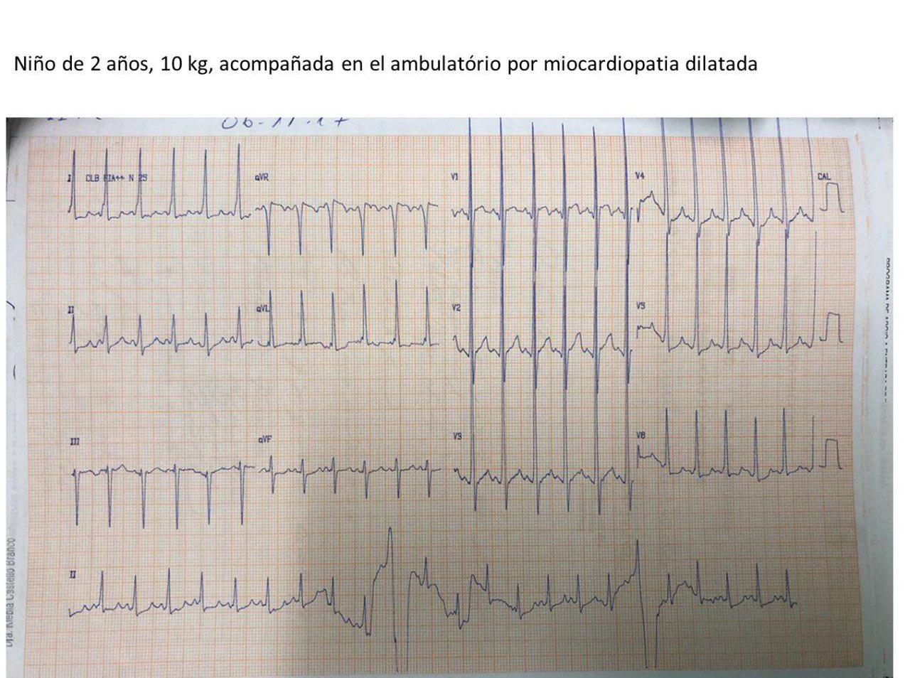 Niño de dos años portador de mocardiopatía esponjosa asociada a WPW