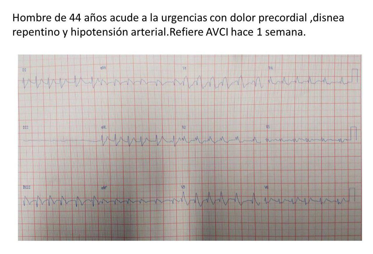 Hombre de 44 años con antecedente cercano de ACV presenta dolor precordial y disnea súbita por TEP