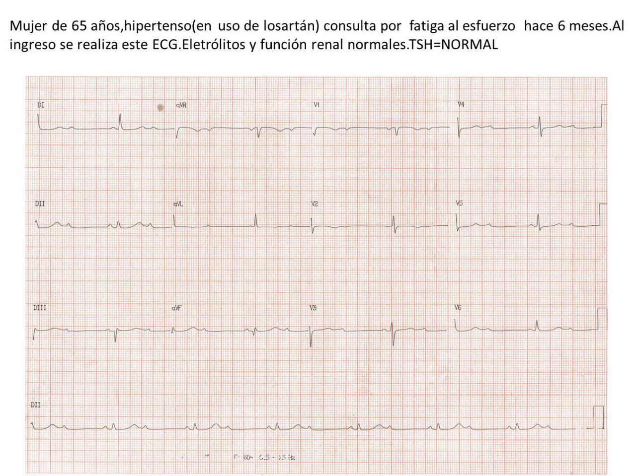 Mujer de 65 años con fatiga de larga data que presenta BAV de alto grado