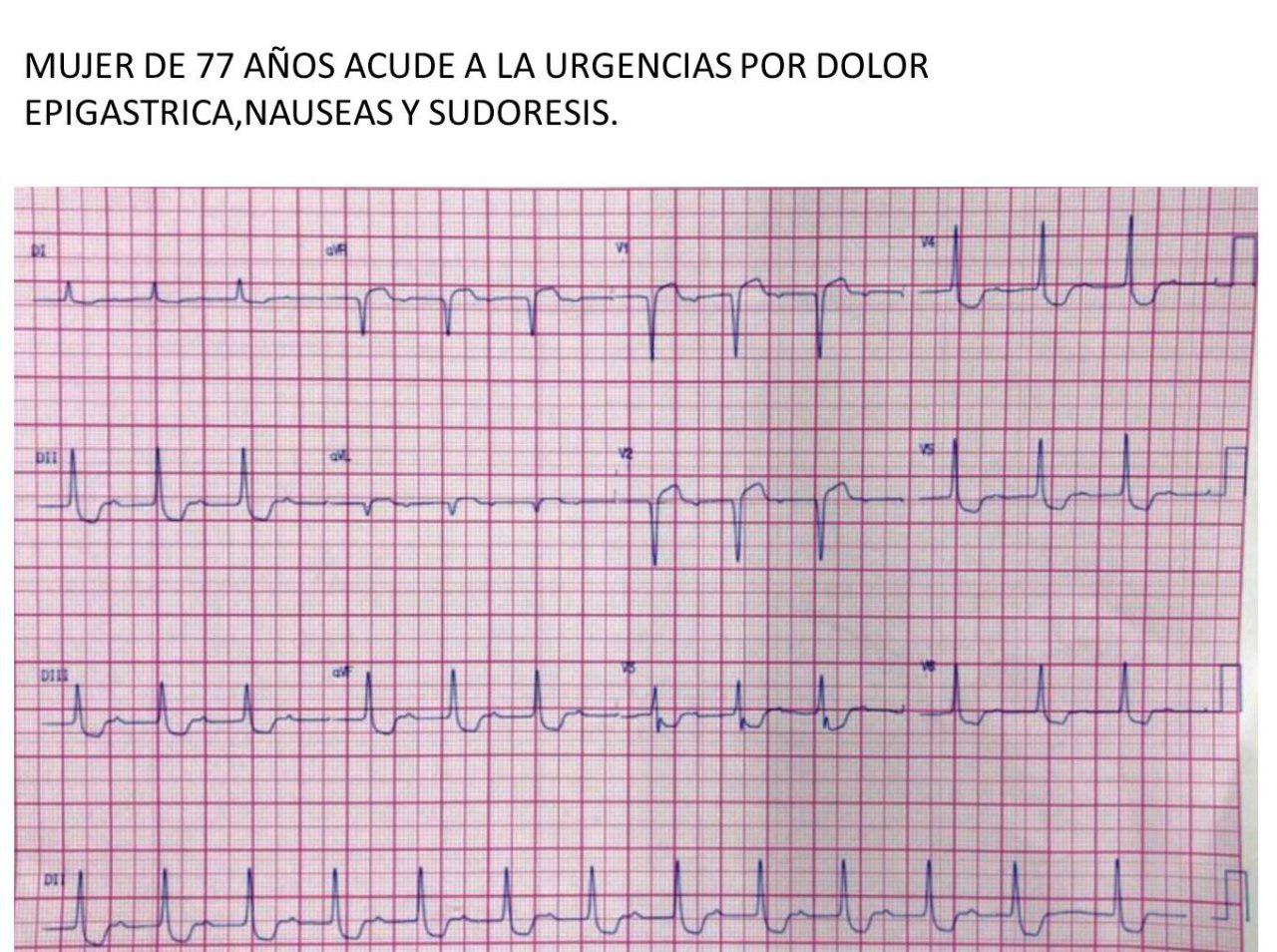 Mujer de 77 años con dolor precordial, nauseas y sudoración con ritmo de la unión por intoxicación digitálica
