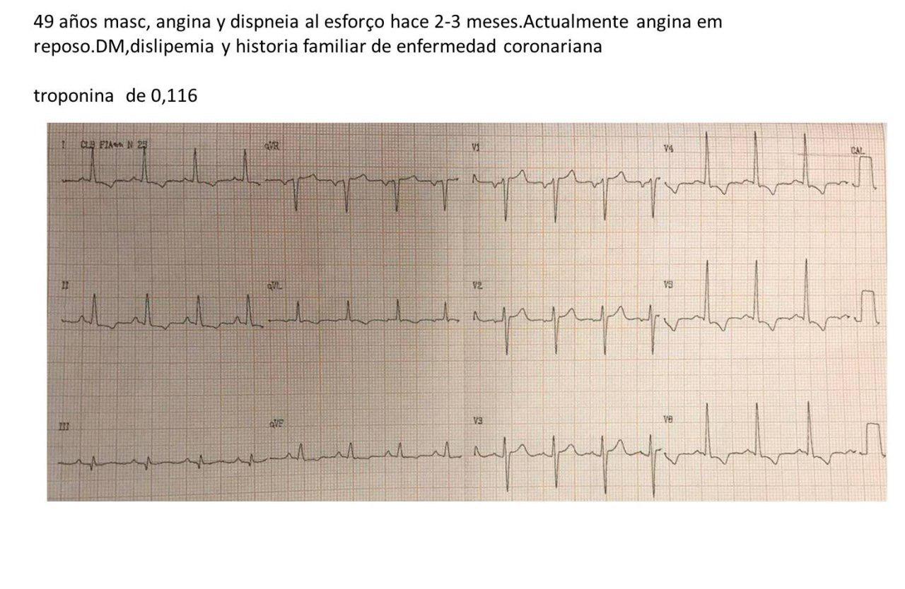 Paciente masculino de 49 años con disnea y angor progresivo que se hizo de reposo por presentar severa enfermedad coronaria y una aorta de porcelana