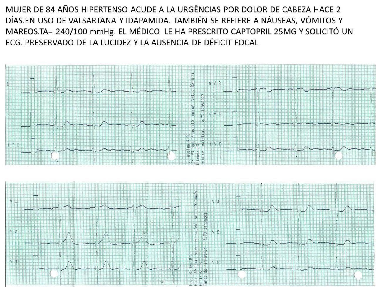 Mujer de 84 años, hipertensa con intensa cefalea náuseas y vómitos que presenta CCG normal, cuadro que es interpretado como miocardiopatía de TakoTsubo