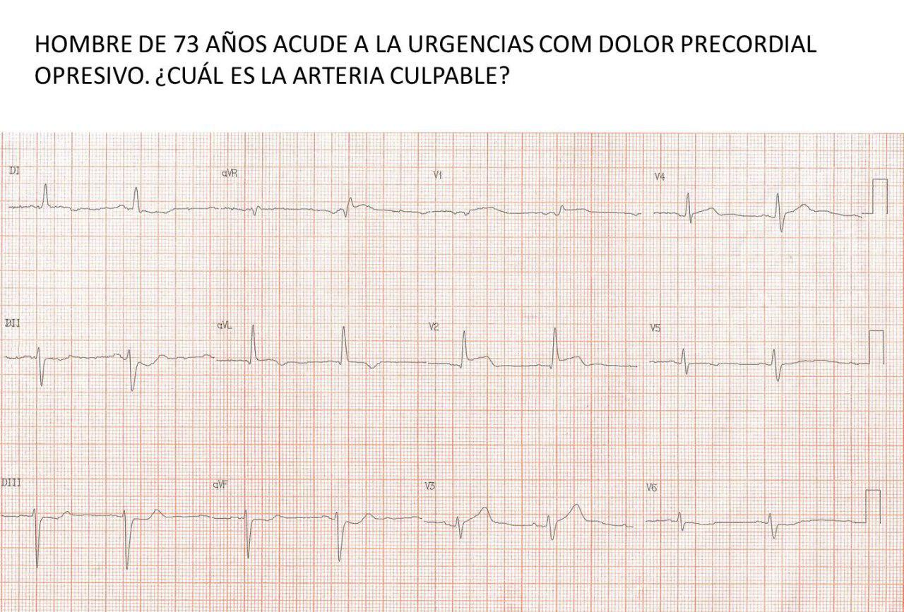 Paciente masculino de 73 años con angor prolongado con supradesnivel ST en aVL por compromiso de arteria DA proximal
