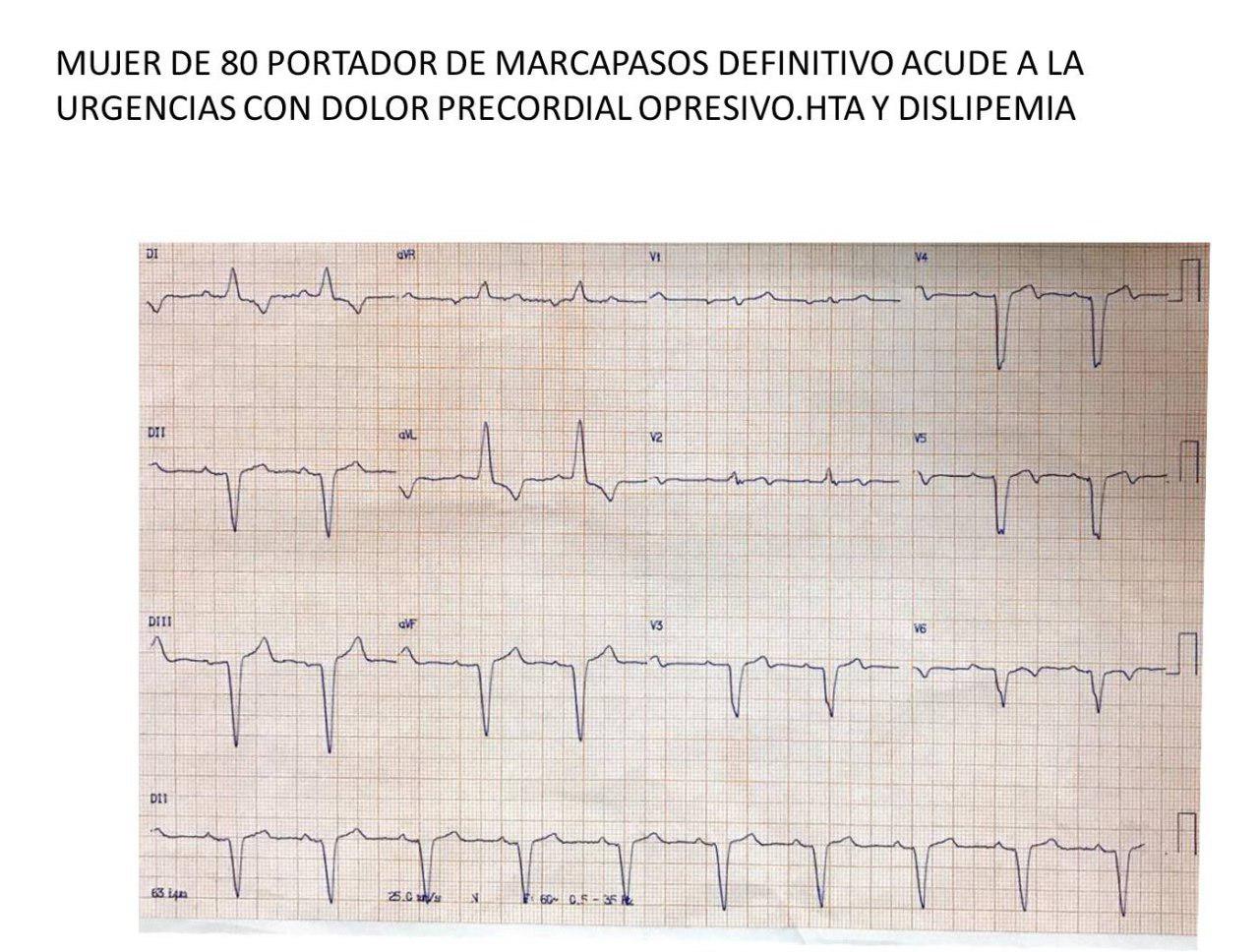 Mujer de 80 años con factores de riesgo y MP implantado que presenta episodio de angor prolongado por compromiso de arteria Cx que es angioplastiada