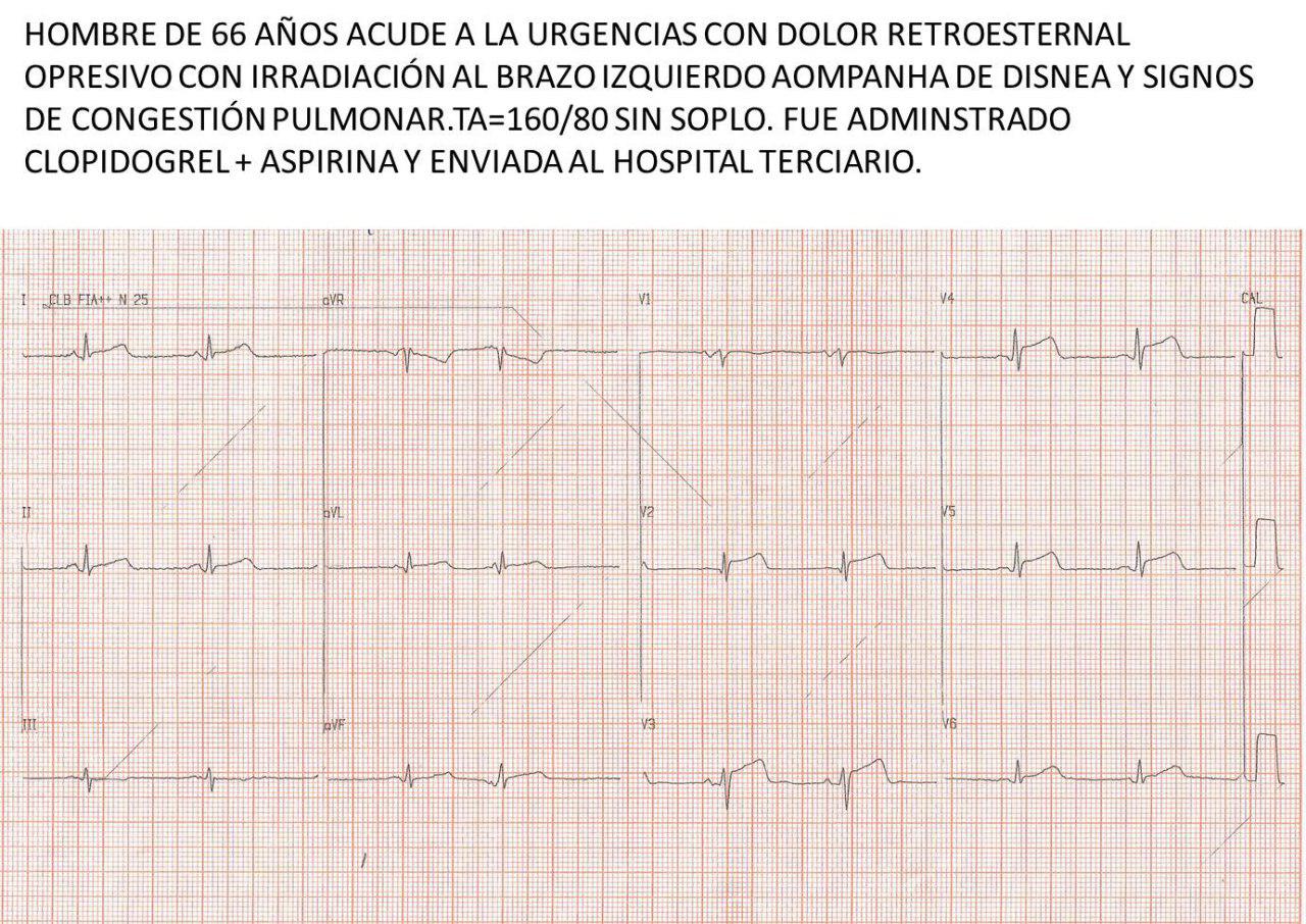 Paciente masculino de 66 años con angor y disnea con signos de congestión pulmonar secundarios a SCA por compromiso de TCI y ECG no típico de lesión de tronco