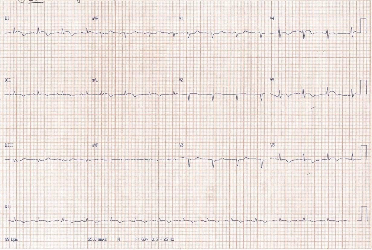 Paciente masculino de 69 años con IRC dialítica que presenta disnea progresiva por derrame pericárdico severo que es drenado